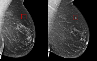MIT Develops Breast Cancer Early Detection Tool