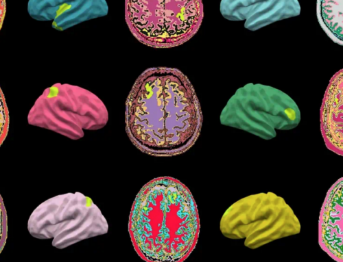 UK Researchers Say AI Detects Epilepsy Oddities